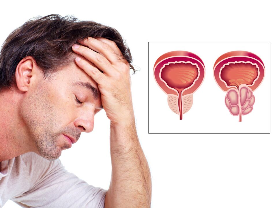 adenom prostate s impotencijom